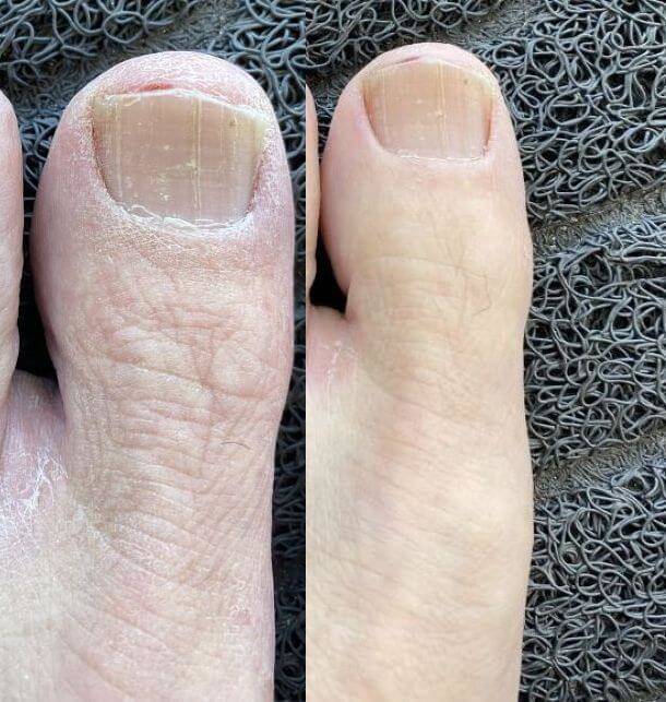 before and after left big toe using hyaluronic acid